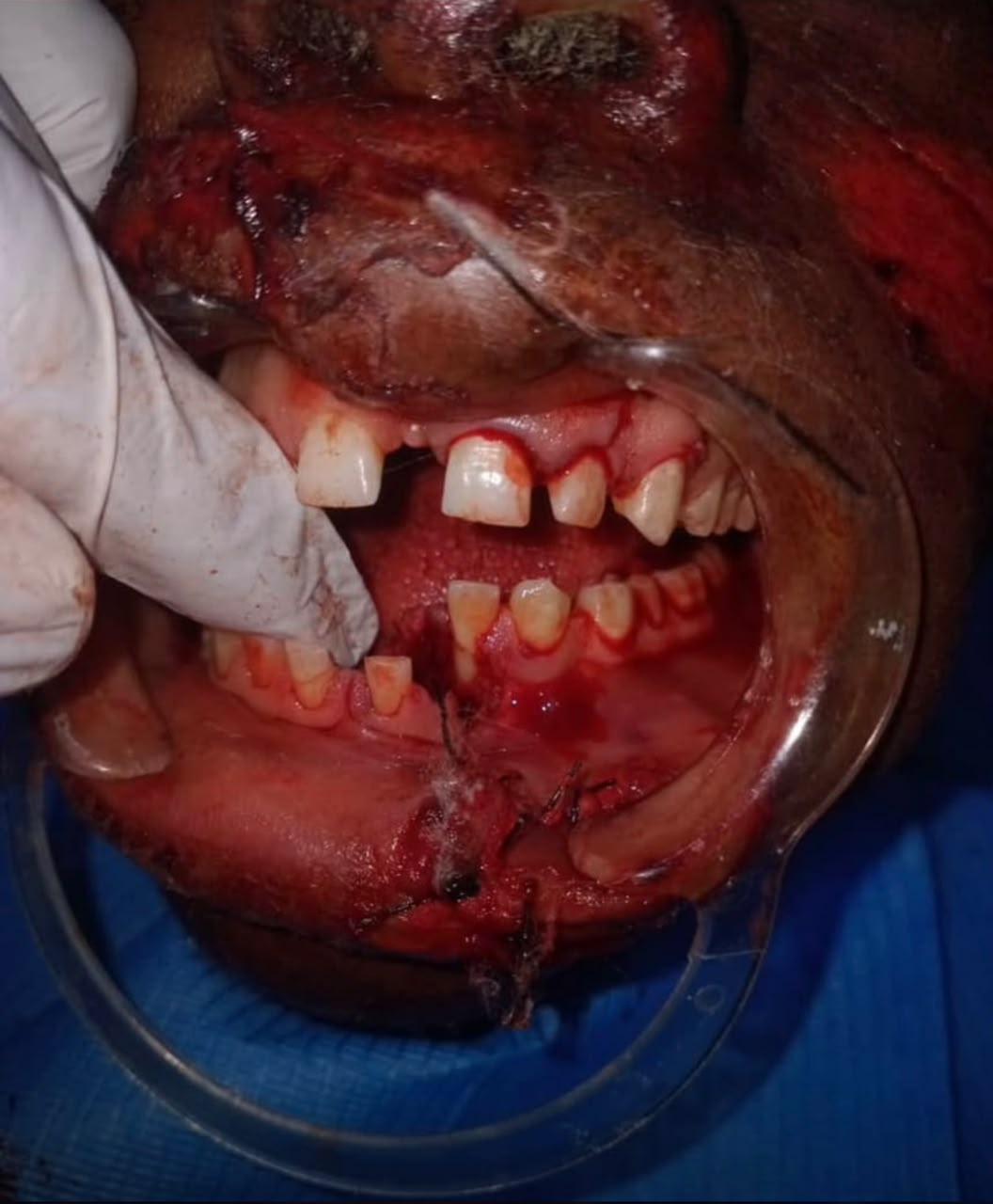 Bright Beam Clinical Case 1