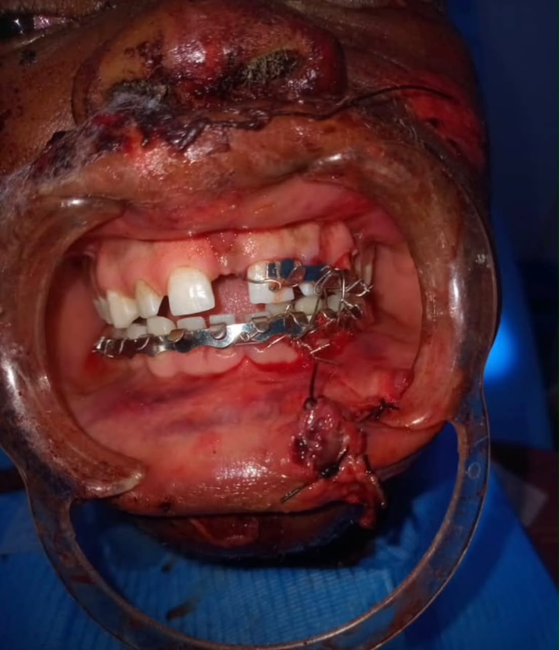 Bright Beam Clinical Case 2
