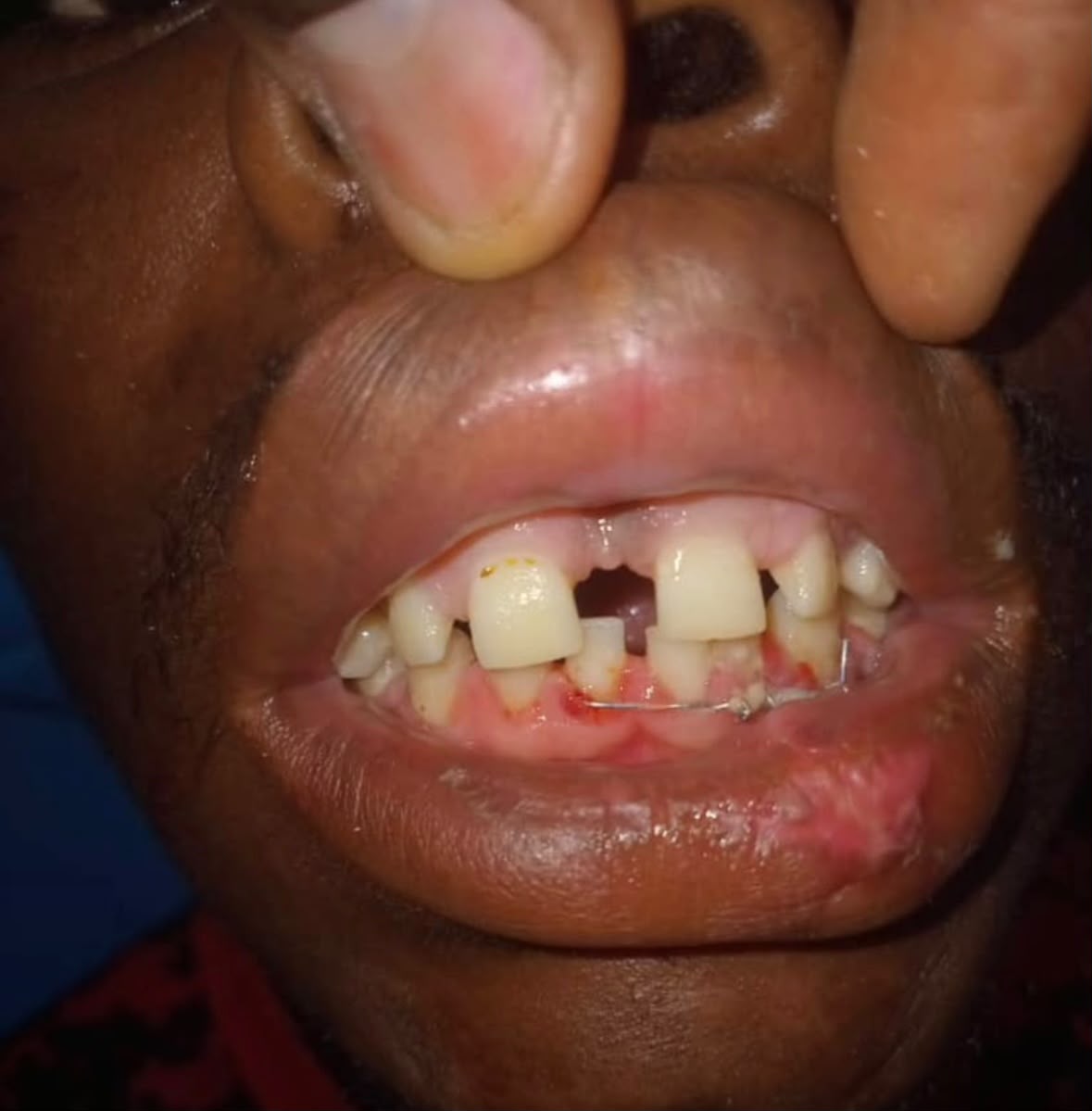 Bright Beam Clinical Case 3